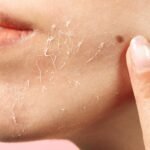 Exfoliation