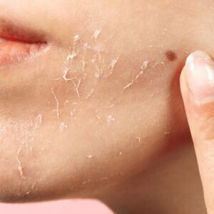 Exfoliation