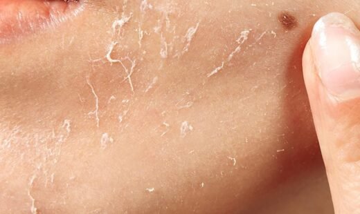 Exfoliation