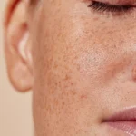Pigmentation