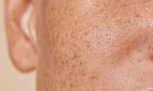Pigmentation