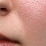 Pores