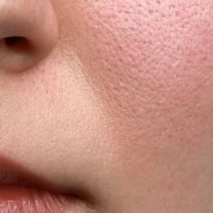 Pores