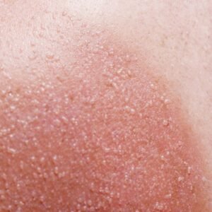 Sun Damage