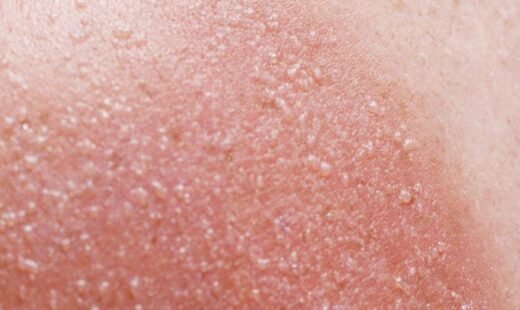 Sun Damage